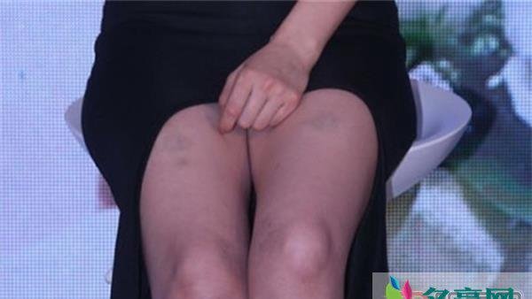 高圆圆大腿多处淤青怎么回事 结婚前的事了后来就被媒体写成家暴