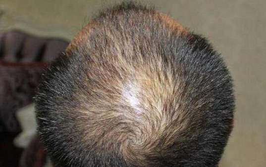 男子回应“不用洗发水变满头黑发”：清水洗头只是一方面，他还做了什么？