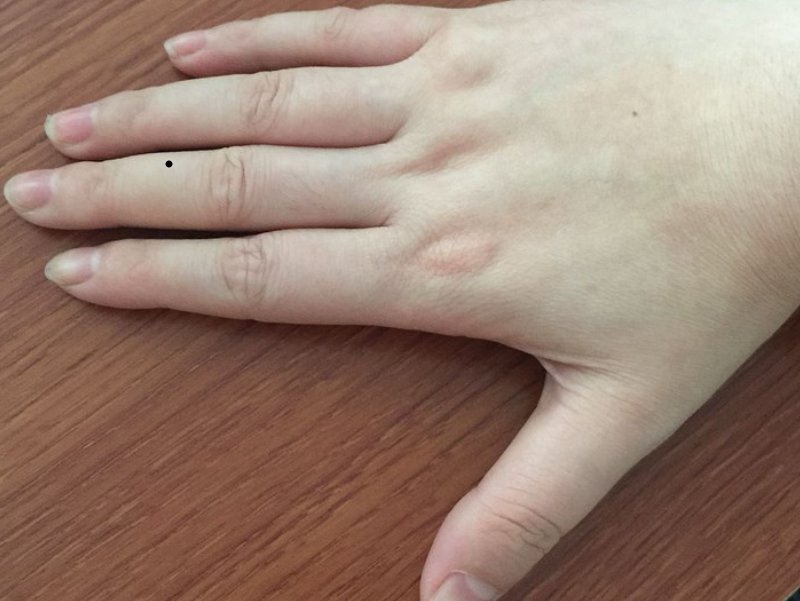 手背痣的各个部位详细图