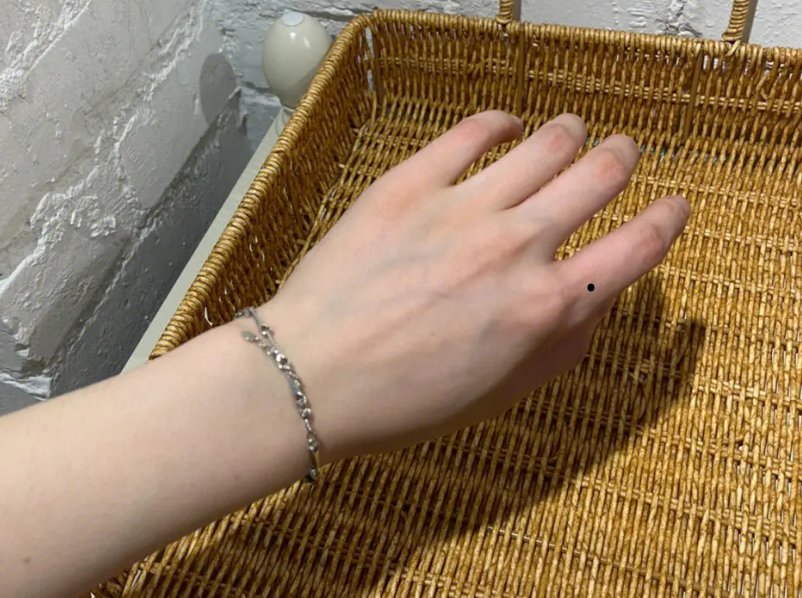 手背痣的各个部位详细图