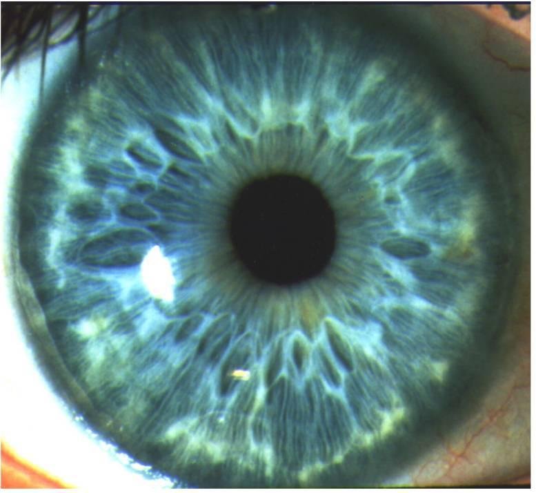 虹膜定位的虹膜定位的特点