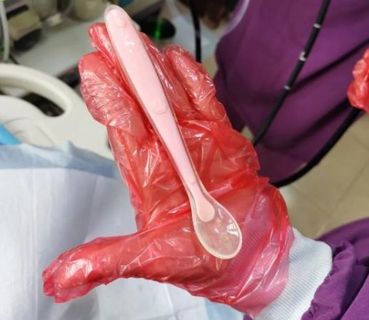 广东女子抠喉误吞17厘米长勺至十二指肠，医生最终是如何将其拿出的？