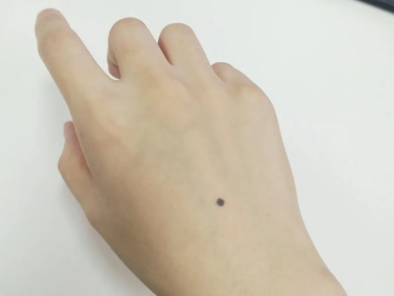 手背痣的各个部位详细图