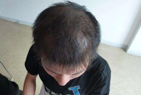 男子回应“不用洗发水变满头黑发”：清水洗头只是一方面，他还做了什么？