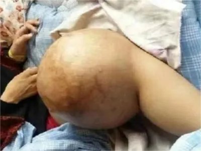 骨肉瘤膝盖肿块图片