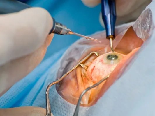 白内障治疗免费吗