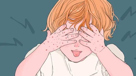 手上的老年斑怎么去除