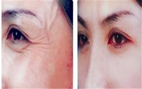 面部注射除皱需要多少钱？