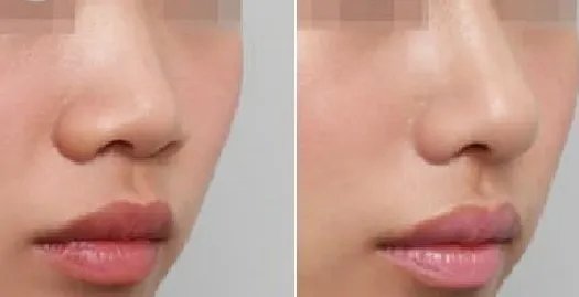 鼻整形前后对比