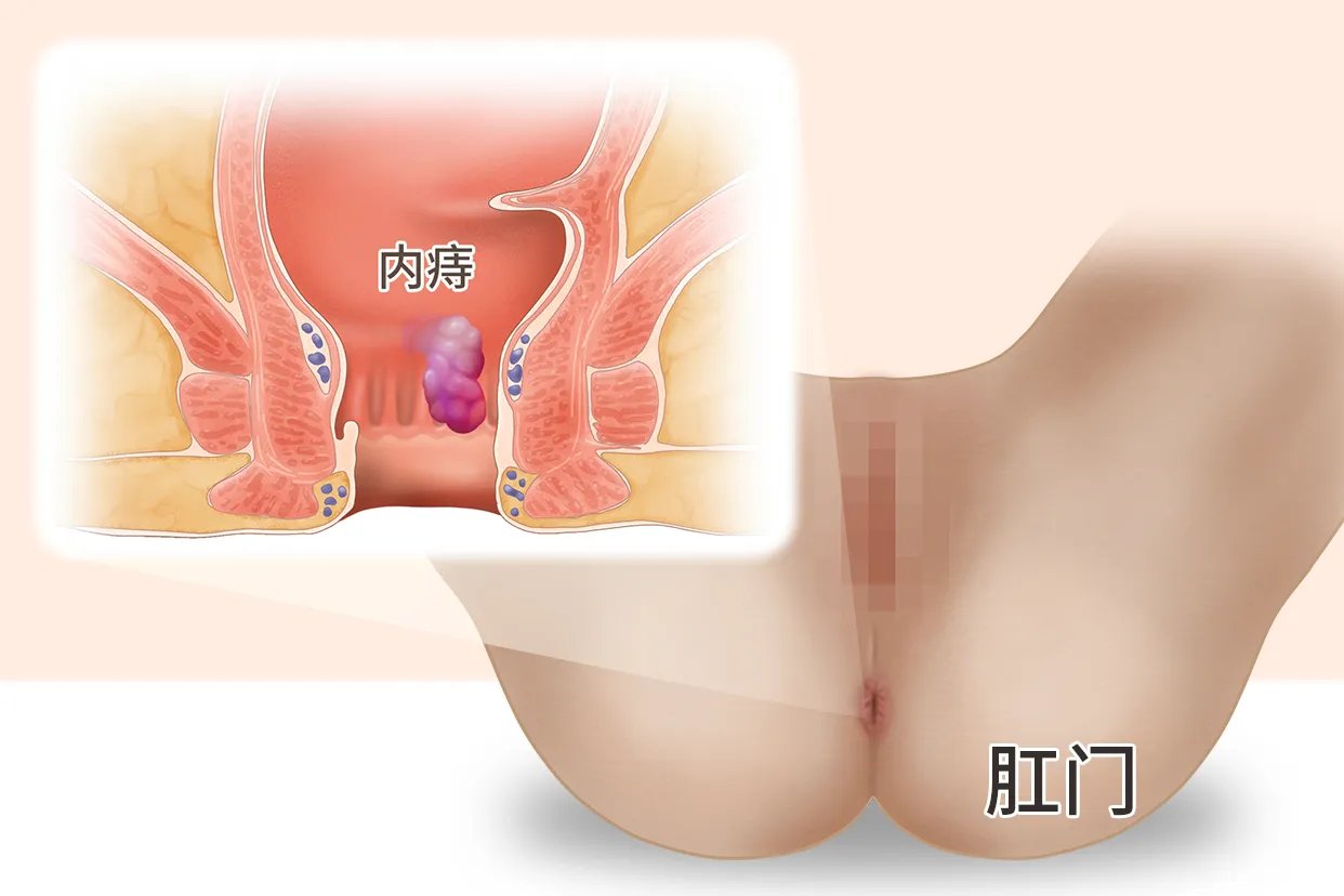 女性内痔疮图片