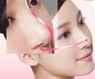 歪鼻子矫正价格