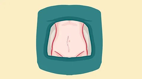 怀孕六个月可以打胎吗