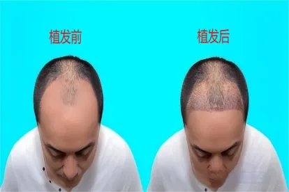 植发1000单位效果图