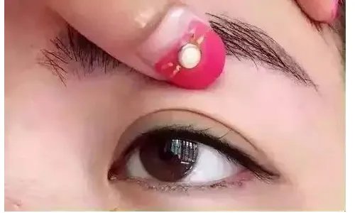 激光割双眼皮怎么样