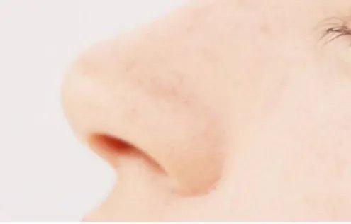 鼻尖整形大概需要多少钱