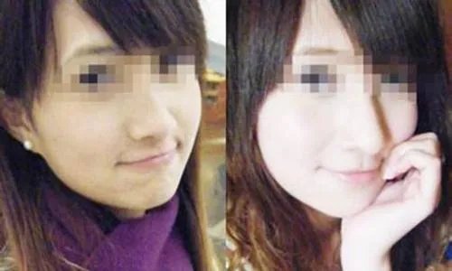 激光美白的价格