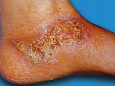 足菌肿症状图片