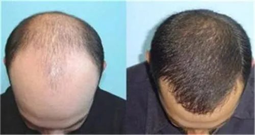 郑州植发fut整形医院哪里好_知名植发fut美容整形医院有哪些【附价格】