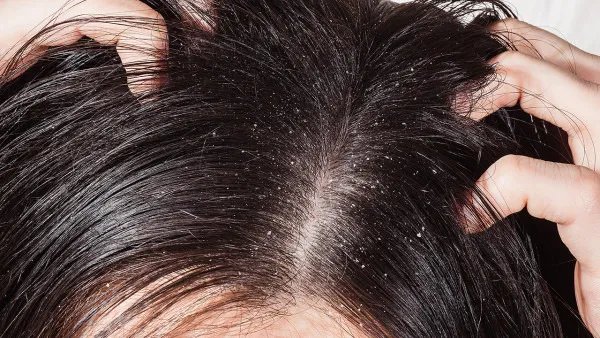 头皮脂溢性皮炎的症状