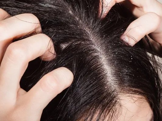 头皮屑很大块怎么办