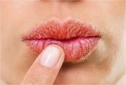 感染新冠嘴唇干裂怎么回事，怎么办