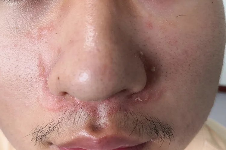 面部脂溢性皮炎症状图