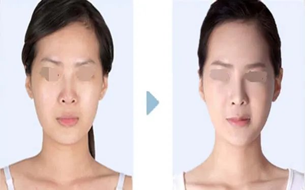 鼻翼整形术多少钱