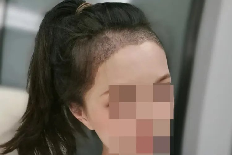 植发恢复过程图片