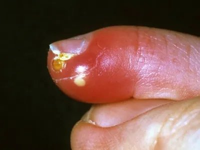 新生儿皮下坏疽症状图片