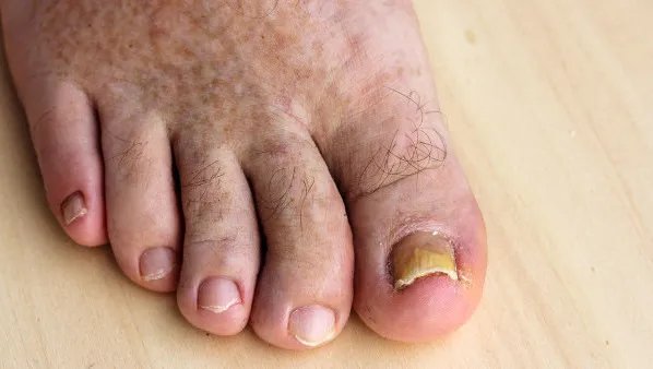 脚指甲变厚怎么治