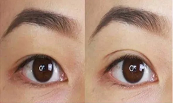 韩式三点双眼皮价格