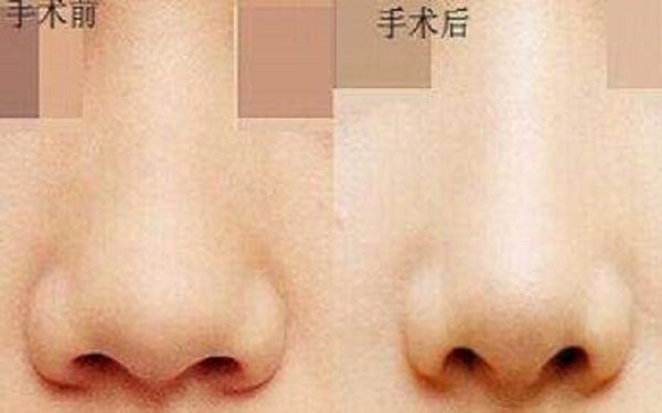 缩小鼻头多少钱