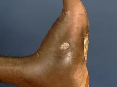 足菌肿症状图片