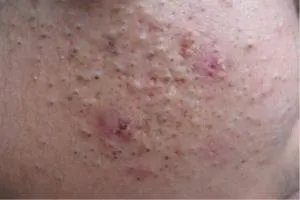 青春痘的特征表现是什么