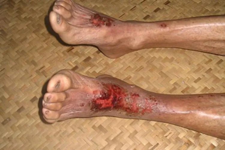 皮肤溃疡脚背溃疡图片