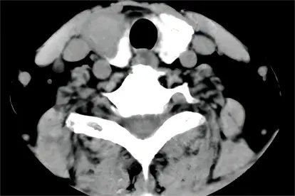 甲状腺影像图片