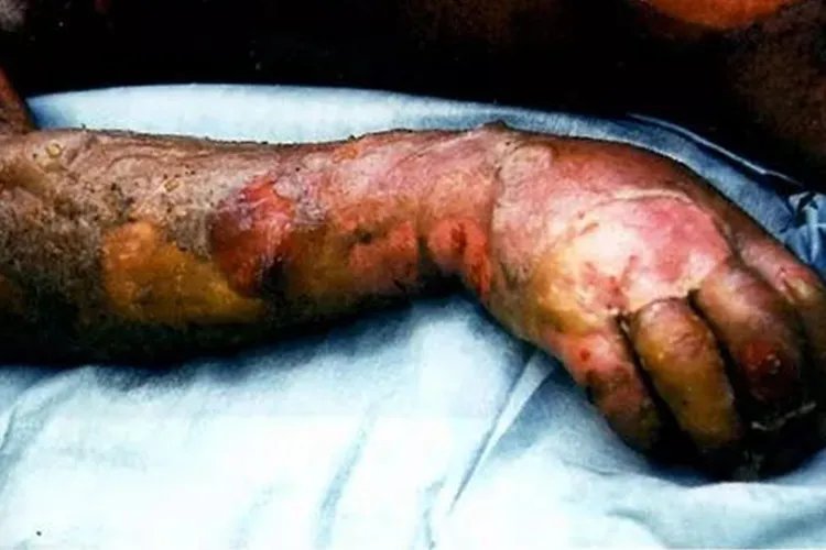 核辐射人体后的图