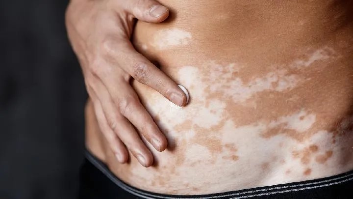 白癜风日常保健方法有哪些?