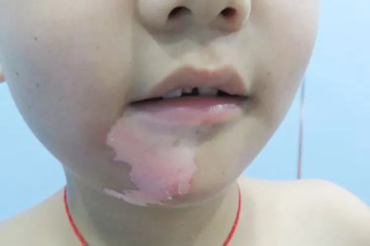 幼儿白斑早期图片大全