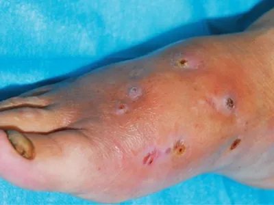 足菌肿症状图片