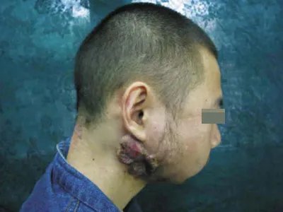 疣状癌颈部肿块图片