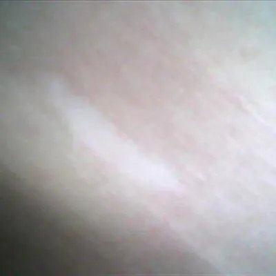 白颠疯怎么样治疗好