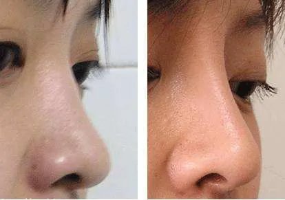 玻尿酸隆鼻价格