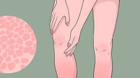 链球菌感染后综合症多久治好