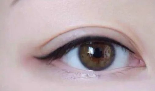 开内眼角手术大概要多少钱