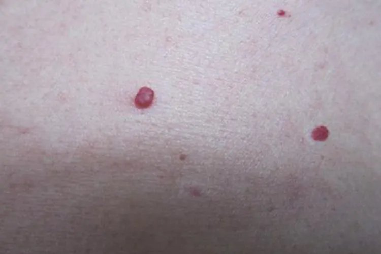 朱砂痣是什么样子图片