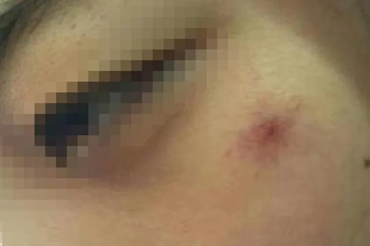 朱砂痣是什么样子图片