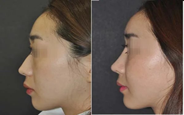 硅胶隆鼻的价格