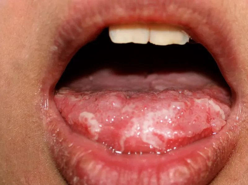 鹅口疮有什么治疗方法