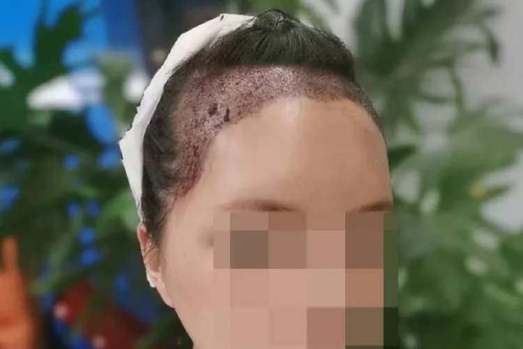 植发恢复过程图片